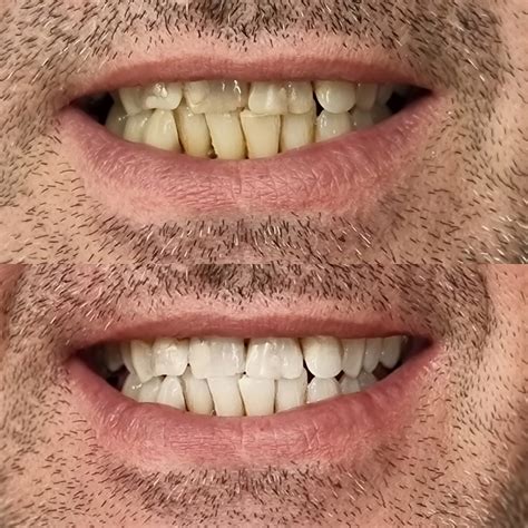 teeth whitening melbourne fl